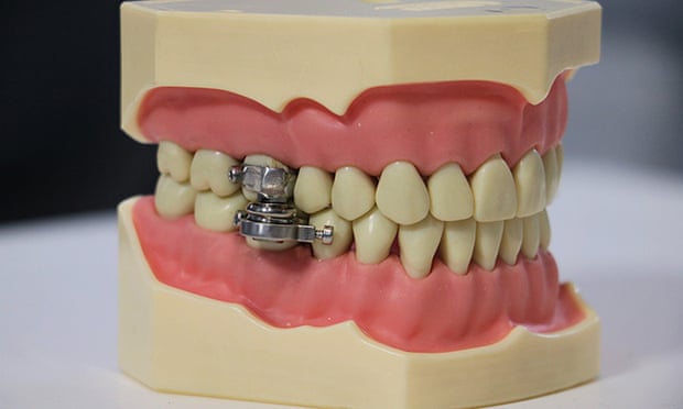 Dental slim diet control