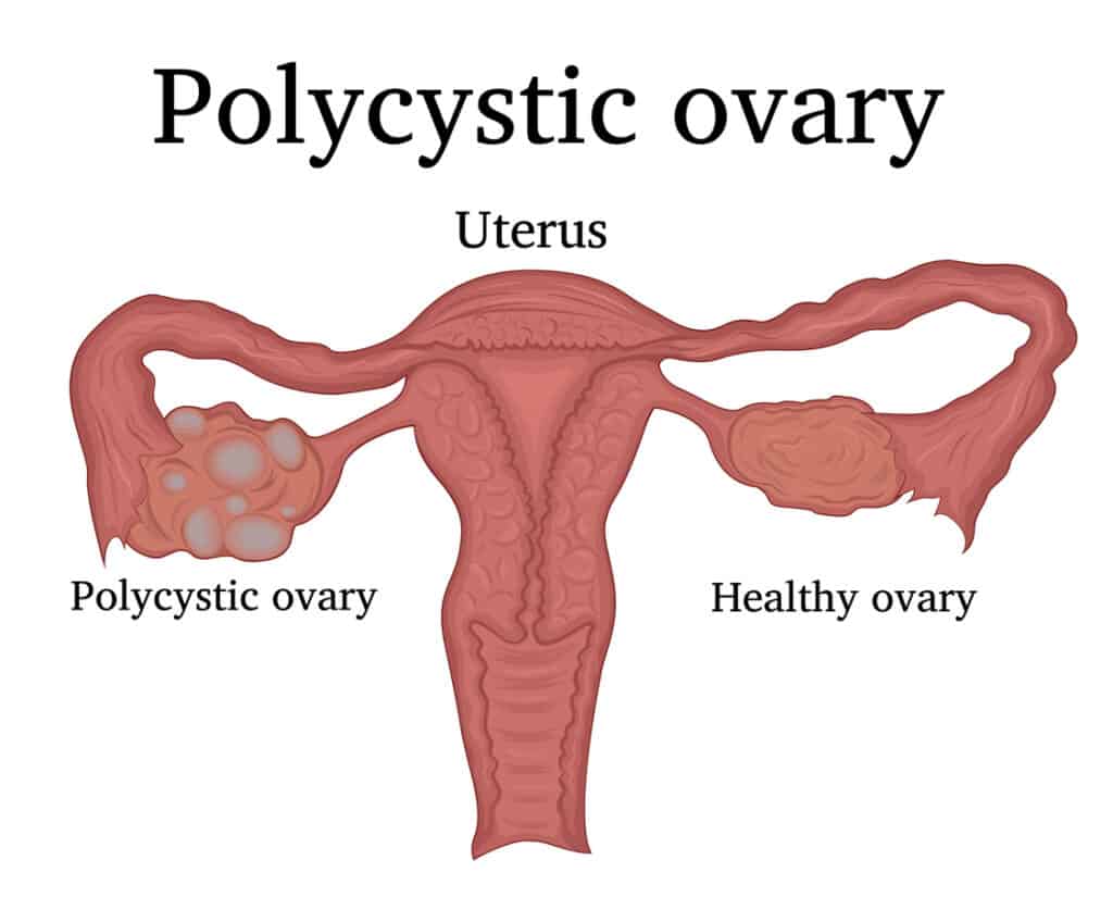 best diet for PCOS