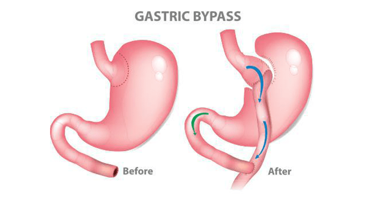 weight loss surgery
