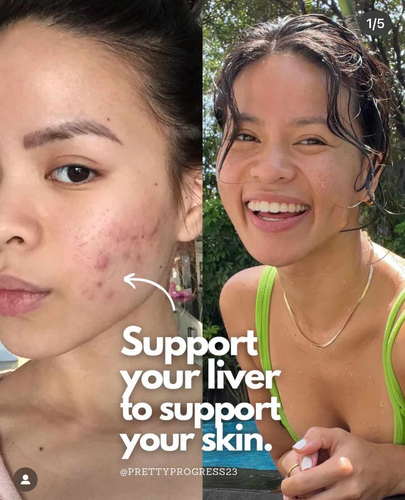 acne and diet